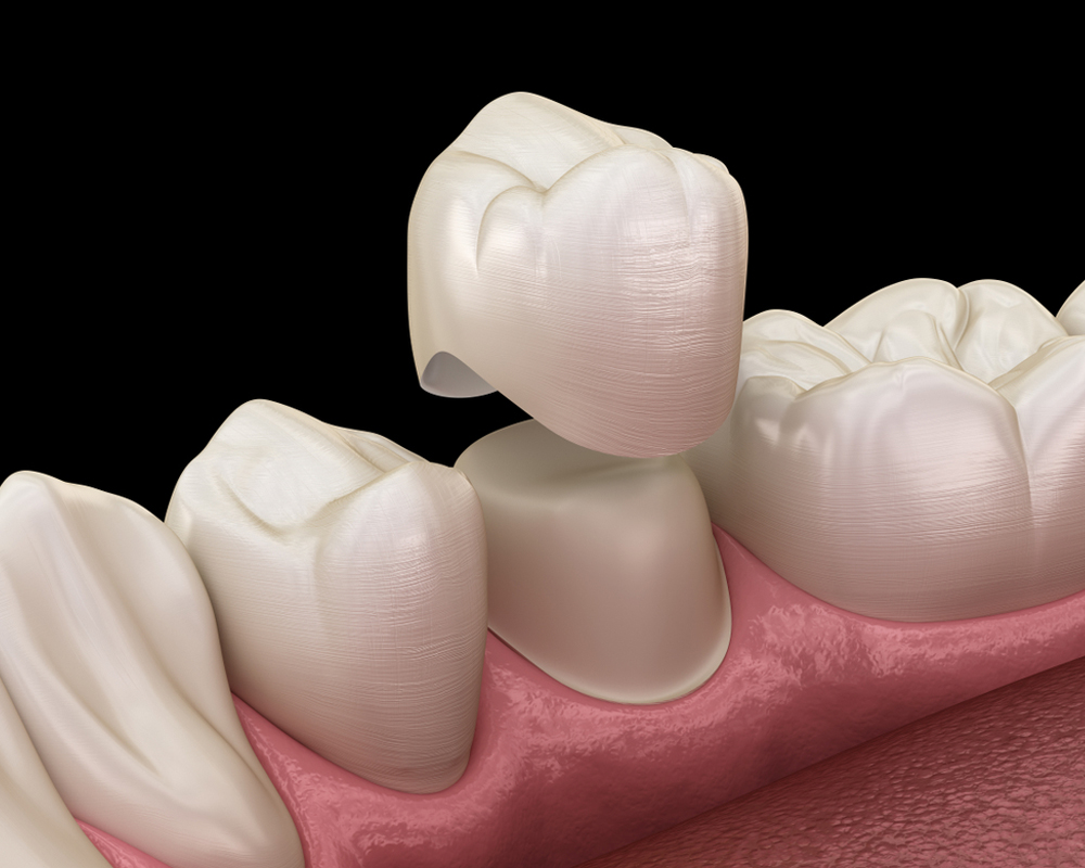 DENTAL CROWNS AND BRIDGES (CAD- CAM)