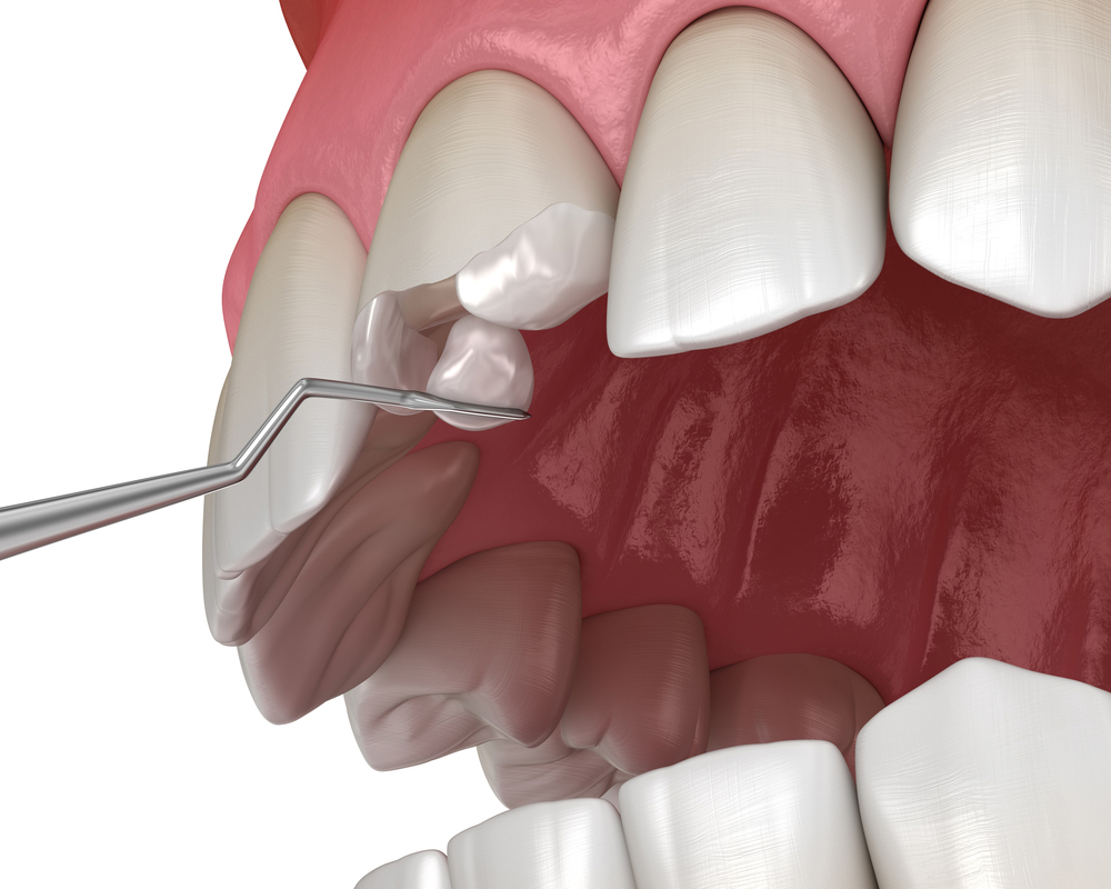 RESTORATION OF TEETH